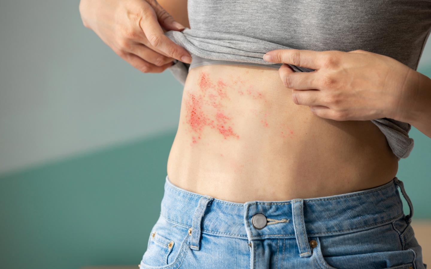 Gürtelrose Symptome, Verlauf und Impfung