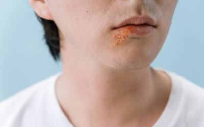 Fieberbläschen schnell loswerden: Was hilft wirklich bei Herpes?